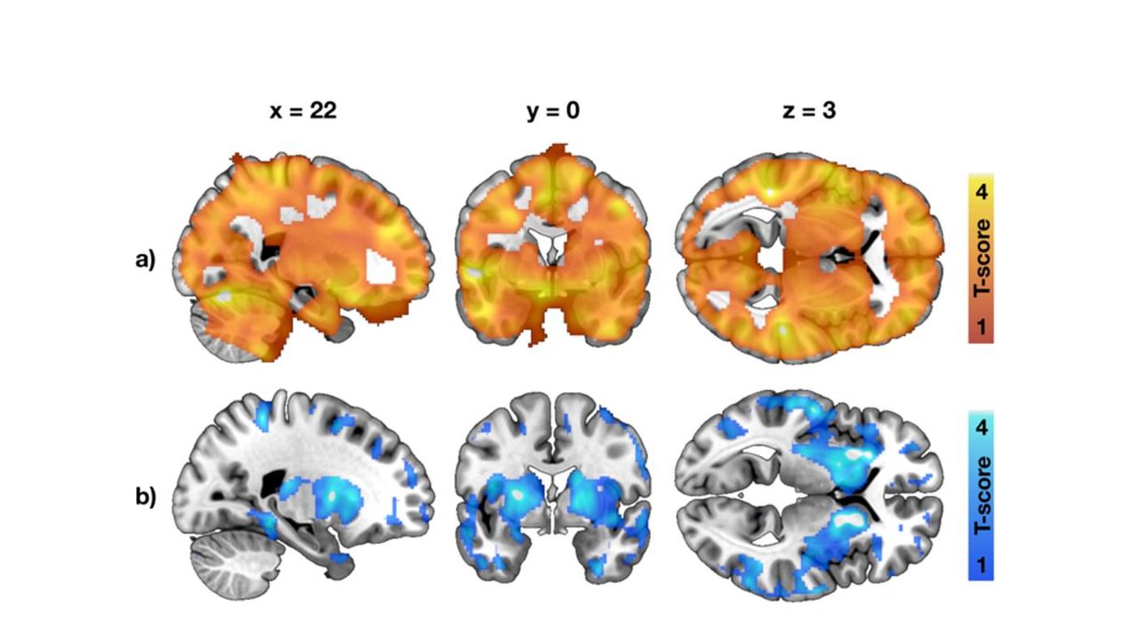 Obesity Risk Factors Revealed by Brain Imaging