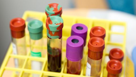 Genome Sequencing Increases Diagnosis of Rare Disorders