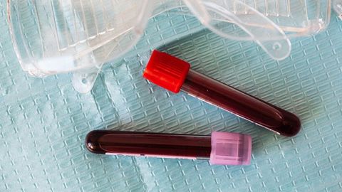 Blood Tests Predict Which Prostate Cancer Patients Are Resistant to Chemotherapy Drug