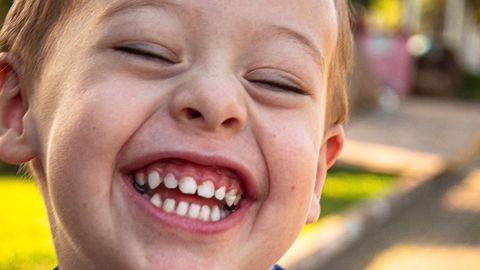 Baby Teeth Markings Could Predict Mental Health in Adulthood