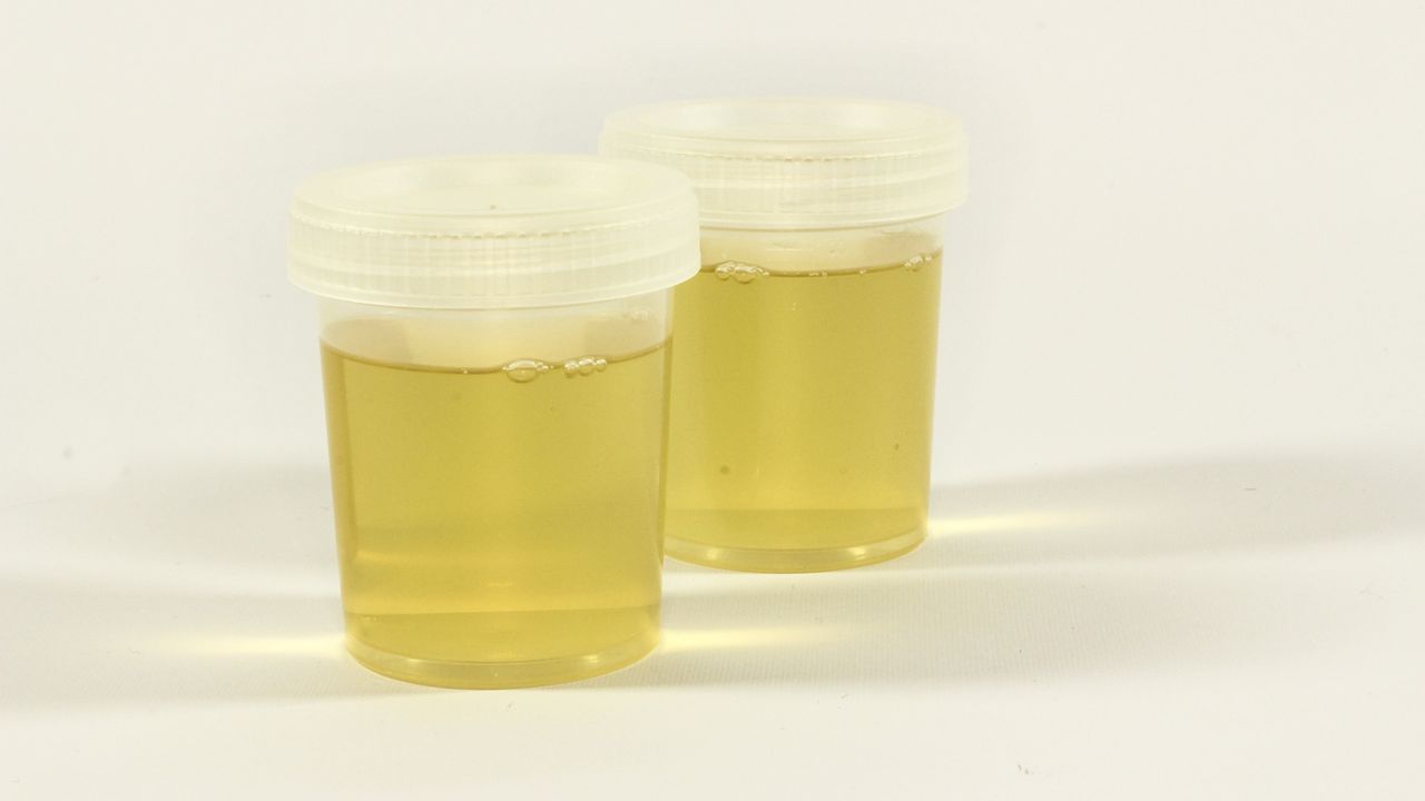 Urine Test Can Detect Urothelial Cancers in Lynch Syndrome Patients