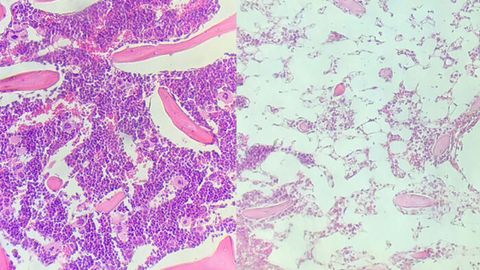 New Technique May Lead to Safer Stem Cell Transplants
