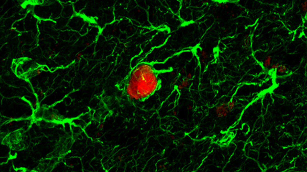 Studying the Life History of Prostate Cancer