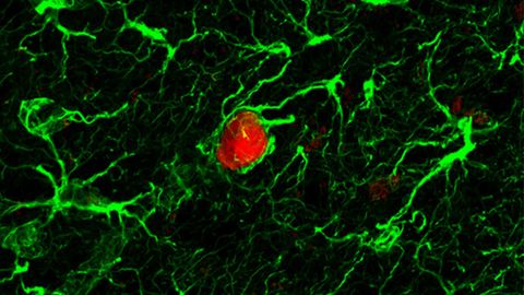 Studying the Life History of Prostate Cancer