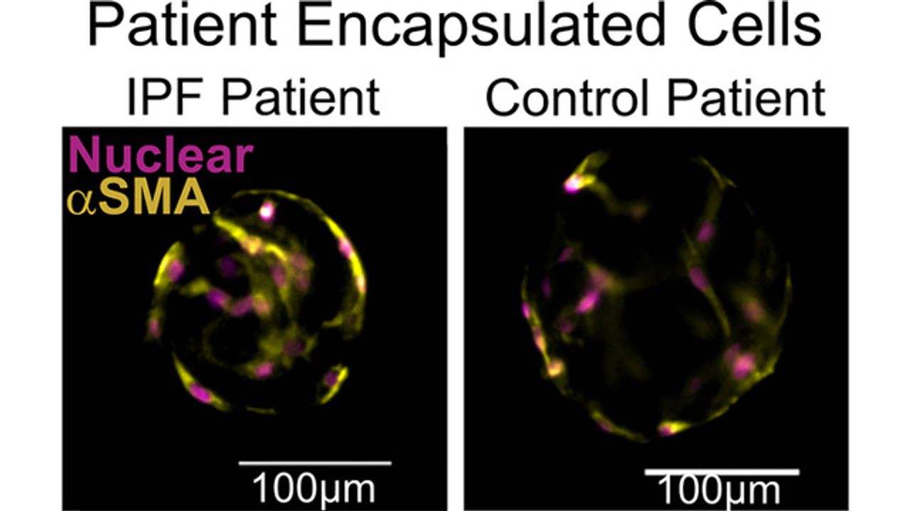 3D Platform Developed To Study Deadly Lung Disease