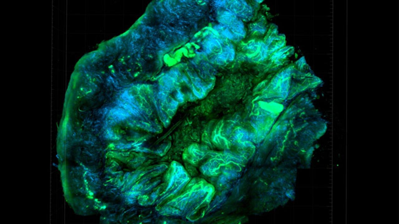 New Assay Enables Patient-Specific Monitoring For Ovarian Cancer