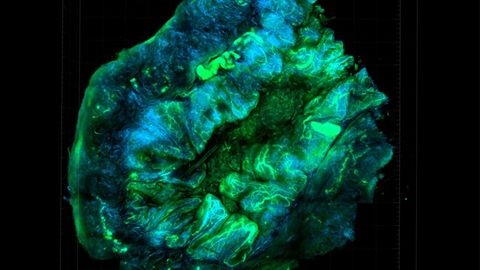 New Assay Enables Patient-Specific Monitoring For Ovarian Cancer