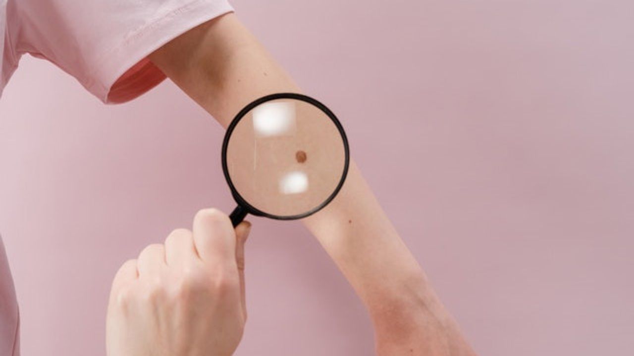 How Do Moles Turn Into Melanoma?