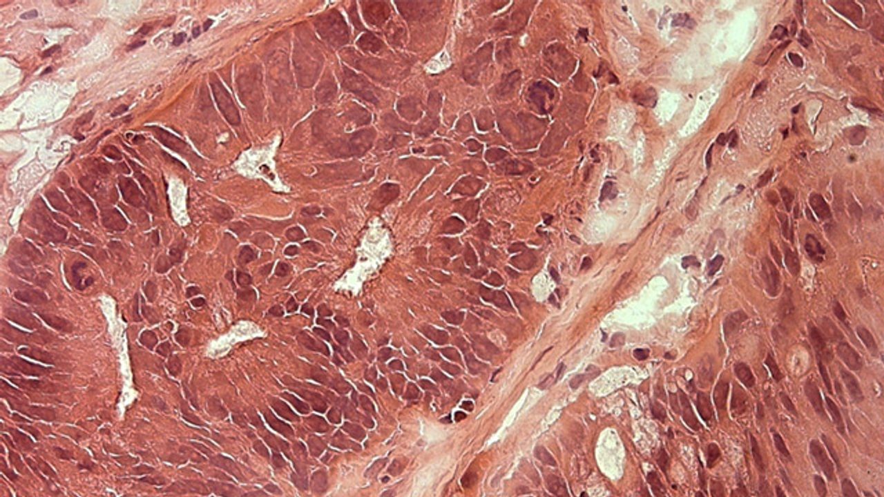 Thin Section of Tumor