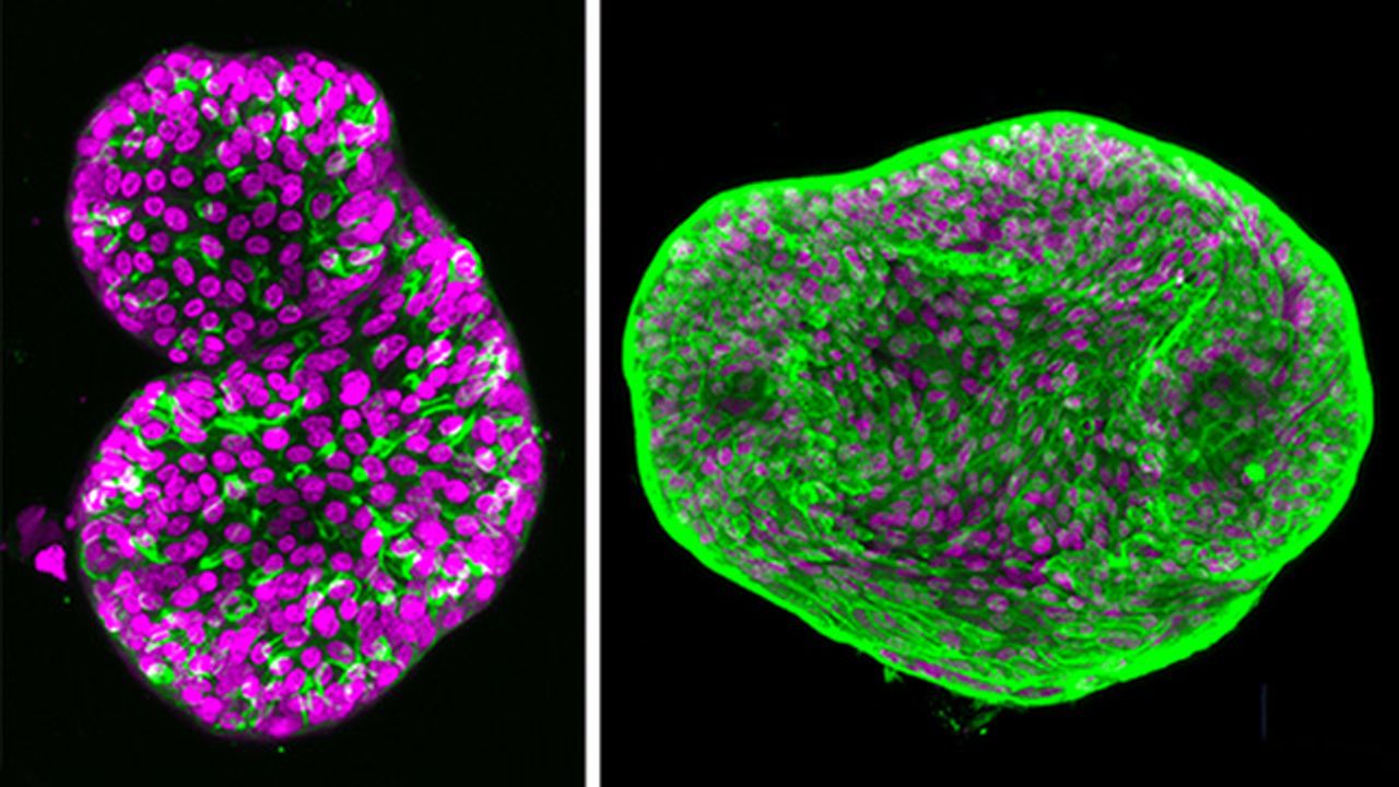 Prostate Cancer Organoids Create Path Towards Precision Therapies