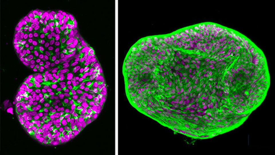 Prostate Cancer Organoids Create Path Towards Precision Therapies content piece image