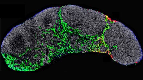 A New Mechanism Involved in Early Melanoma Metastasis