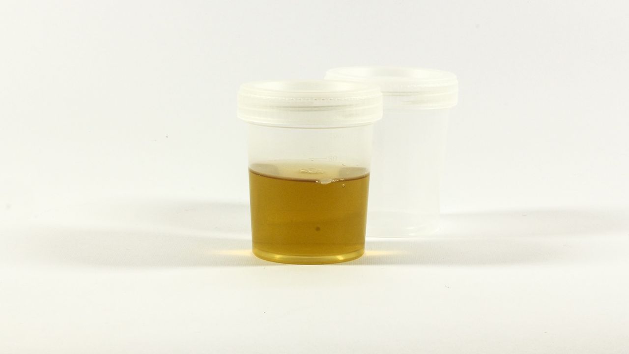 Beckman Coulter's New Urinalysis Solution Improves Laboratory Workflow