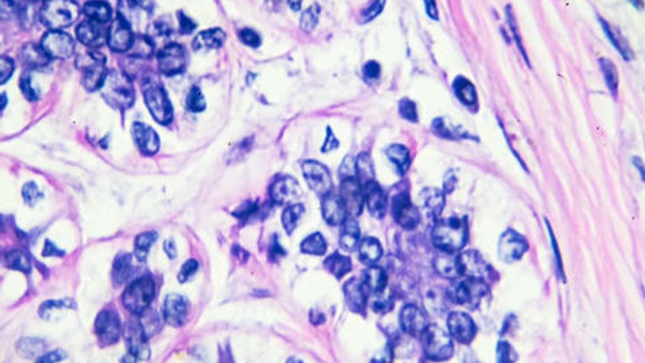Enriching Pathological Analysis of FFPE Tumor Samples With Spatial Transcriptomics