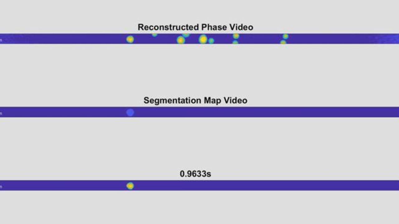 High-Speed Holography of Cells Spots Physical Beacons of Disease