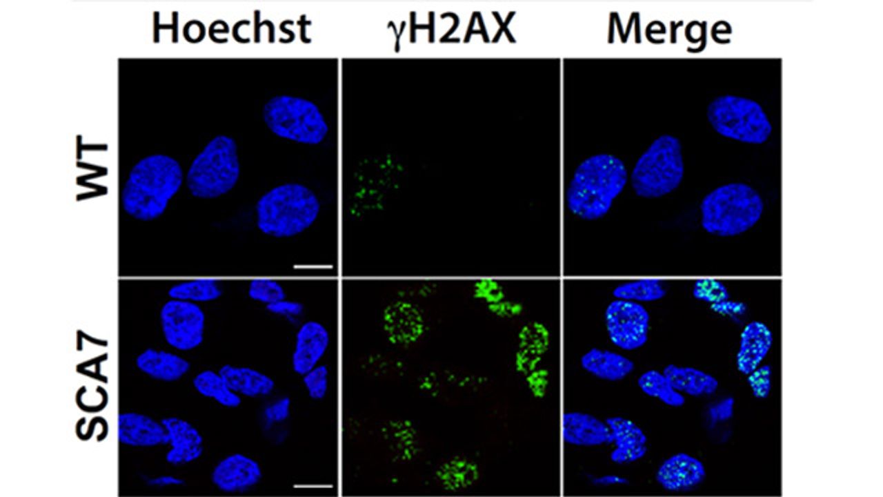 Genetic Underpinnings of Neurodegenerative Condition Uncovered