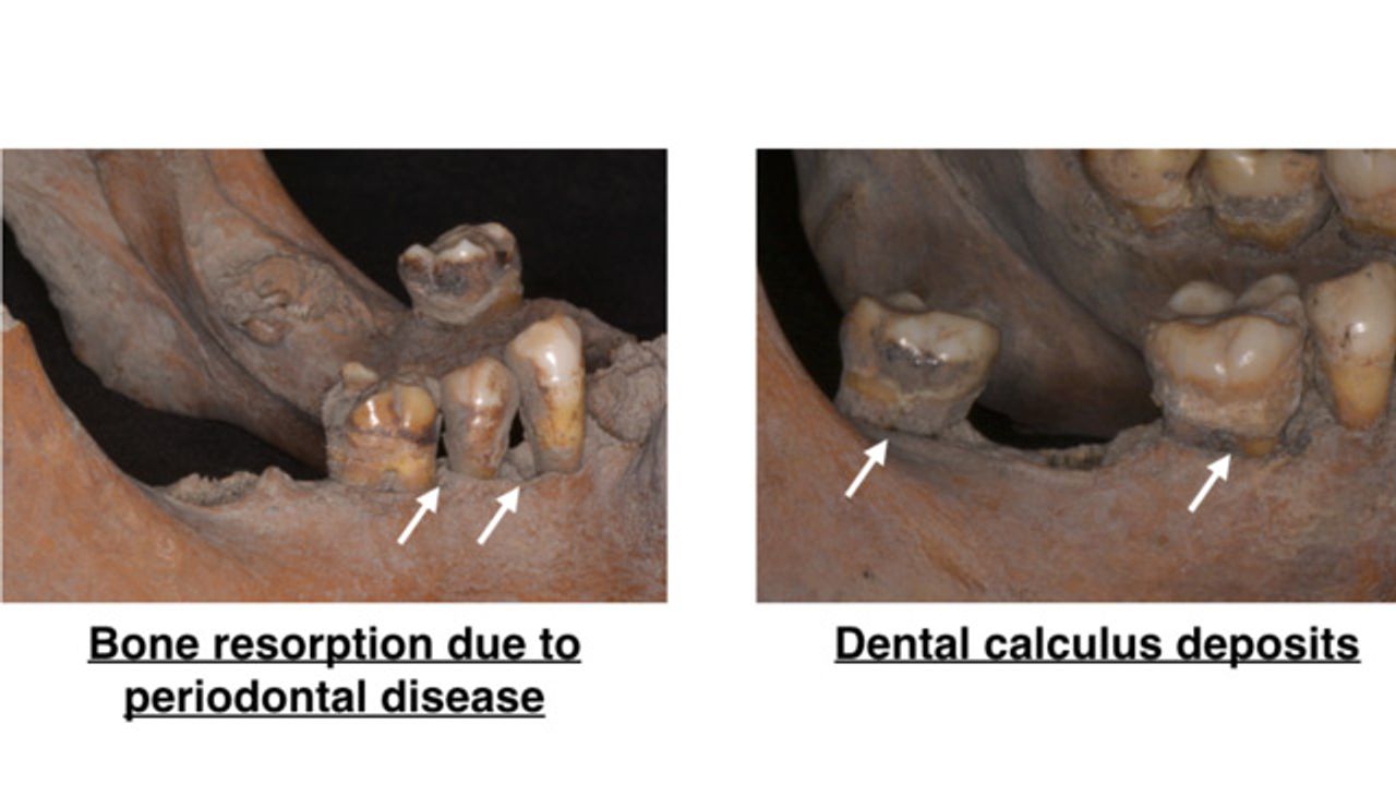 Japanese Teeth Reveal the Bacterial Secrets of Ancient Mouths