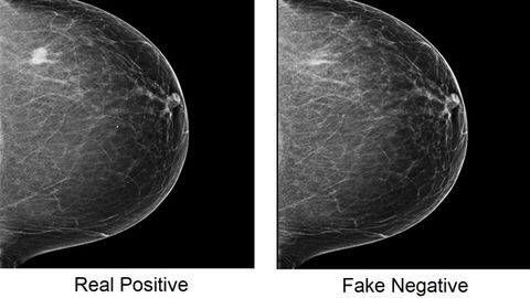 Cancer-Spotting AI Is Vulnerable To Cyberattacks