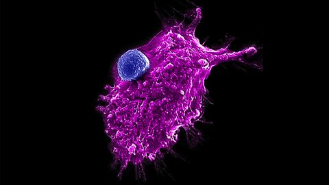 Engineered Cell Attacking a Human Tumor Cell