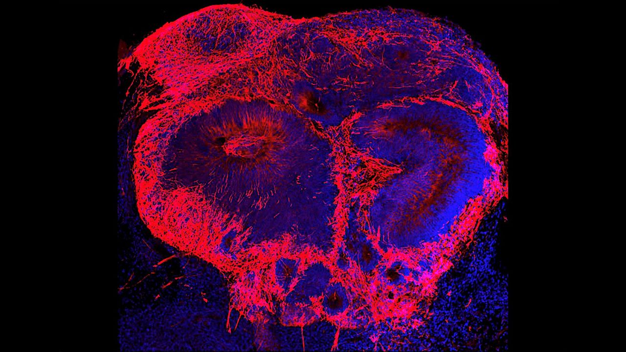 Brain Organoids Reveal Clues About the Origins of Schizophrenia