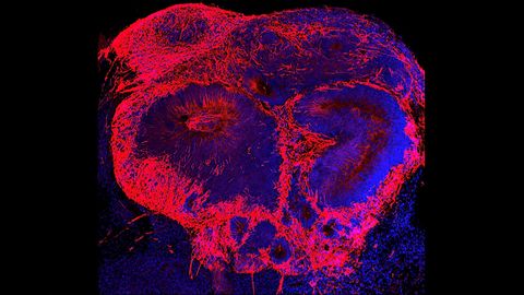 Brain Organoids Reveal Clues About the Origins of Schizophrenia