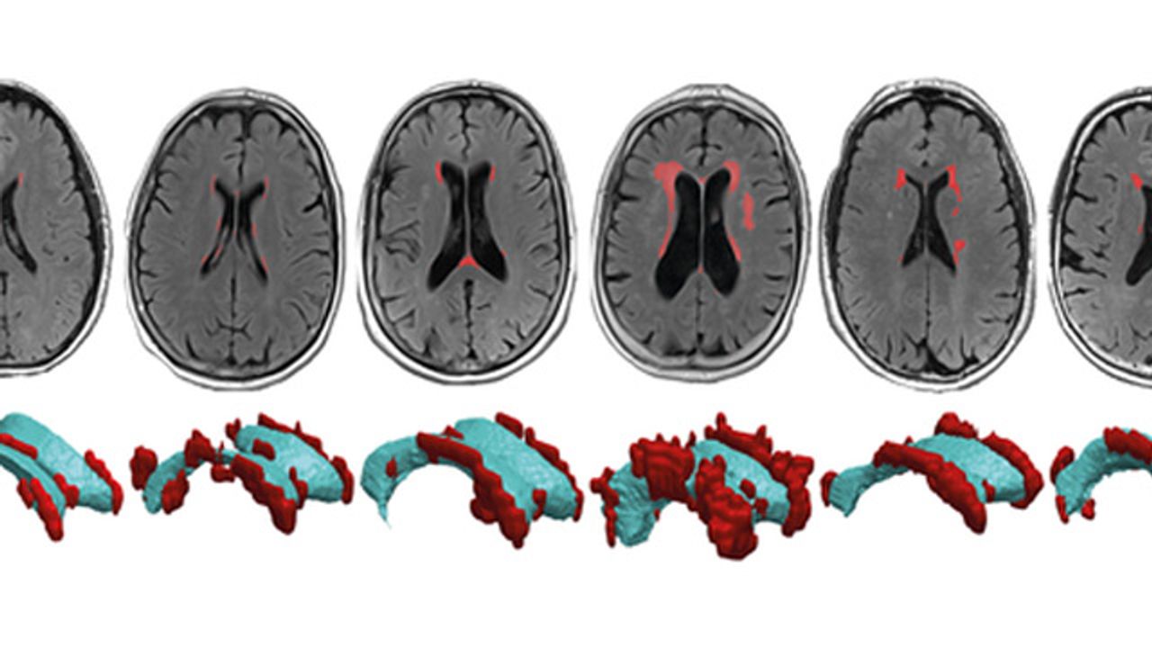Brain Wear and Tear May Lead to Cognitive Decline-Linked Lesions