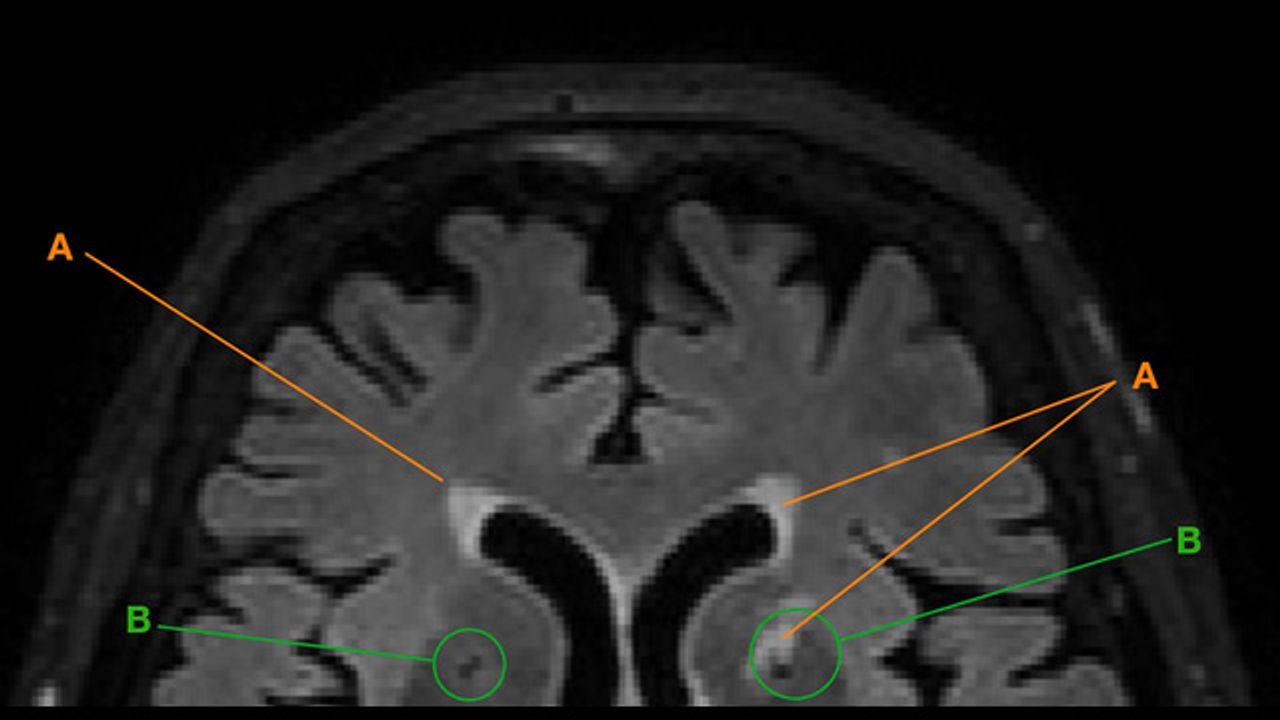Academic Education Can Positively Affect Brain Aging