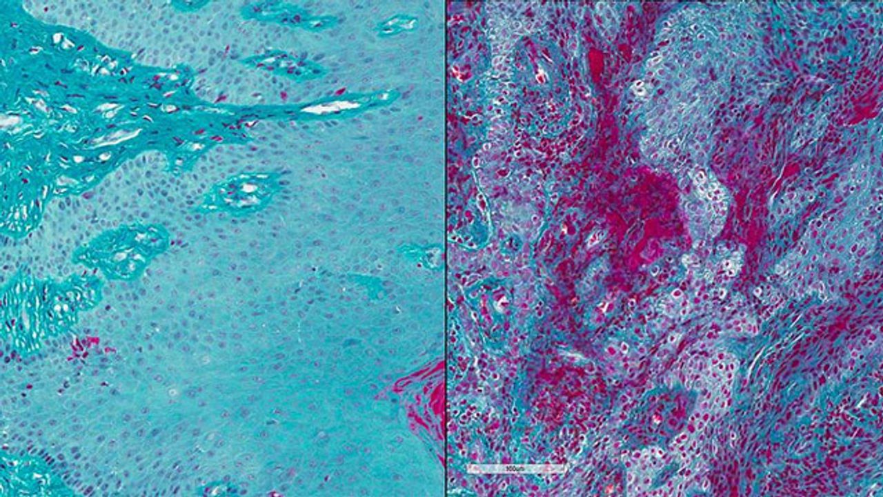 Disarming a Blood-Clotting Protein Prevents Gum Disease in Mice