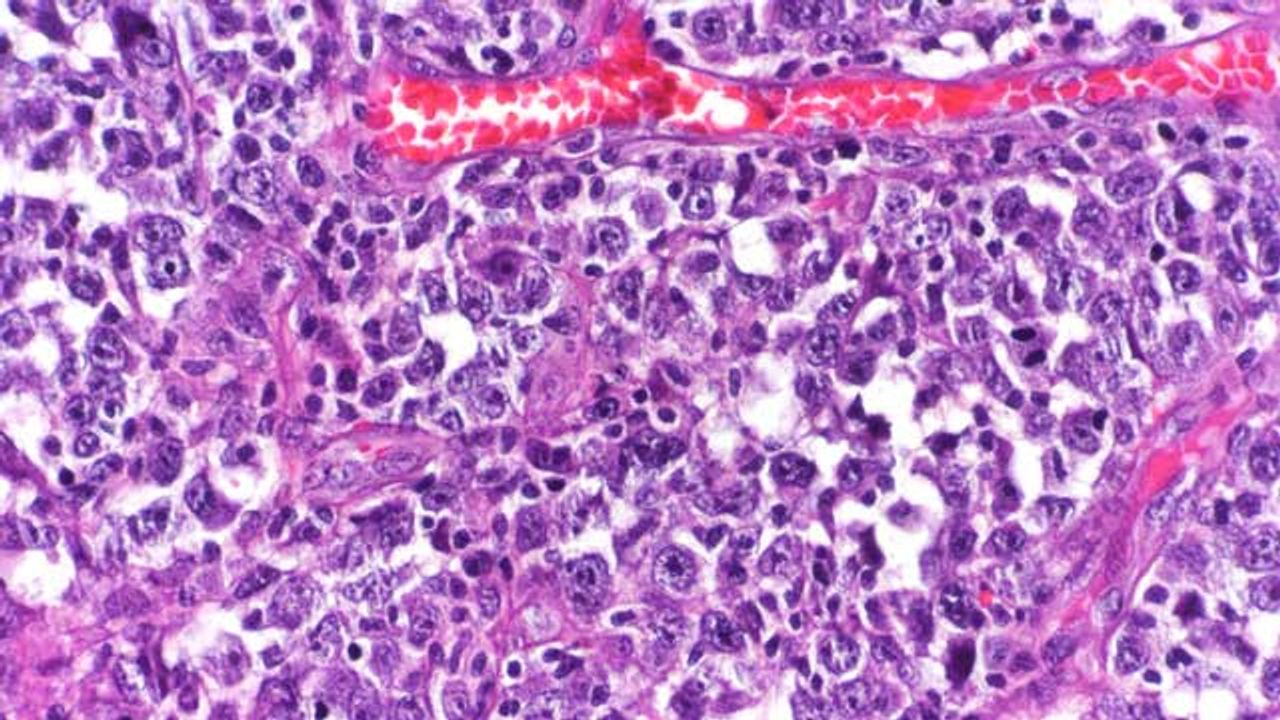 Critical Metabolic Vulnerability Exploited To “Starve” Cancers
