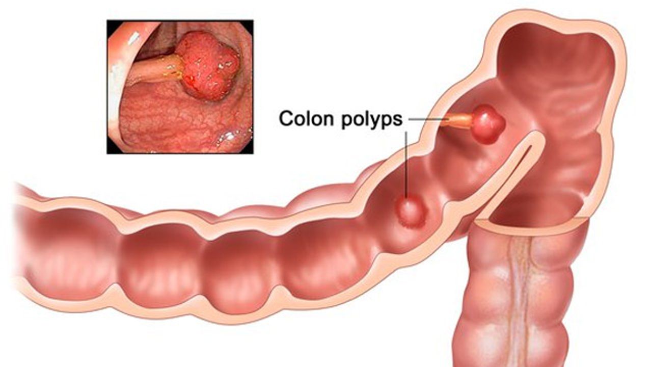 Team Reveals How Polyps Develop Into Colorectal Cancer