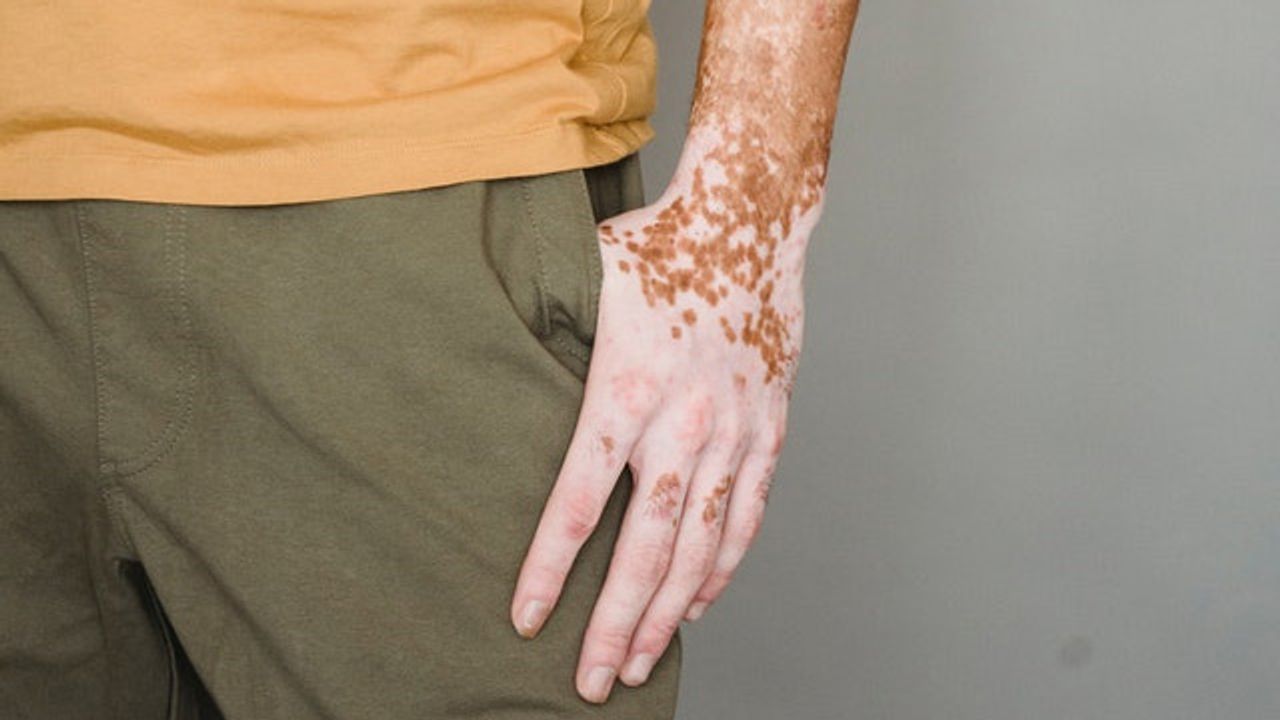 Cellular Mechanisms of Genetic Skin Diseases Uncovered