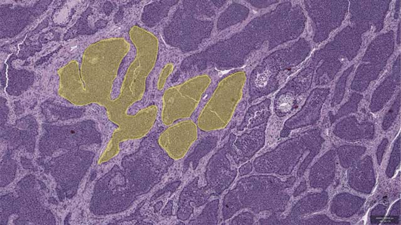 Exploring How Spatial Structure Influences Cancer Evolution