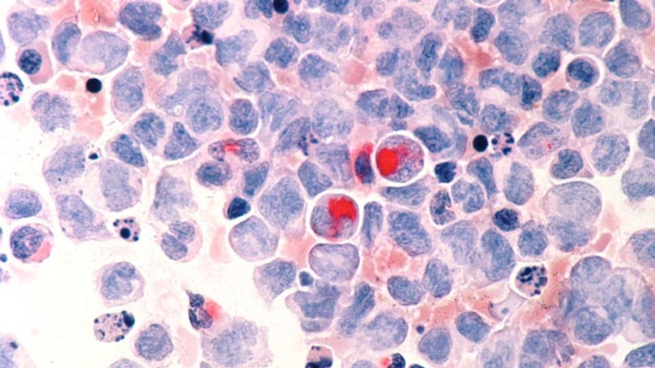 Targeting Bone Cells To Stop Blood Cancers