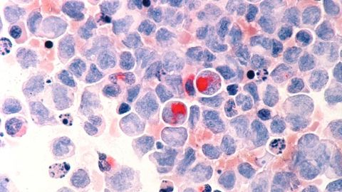 Targeting Bone Cells To Stop Blood Cancers