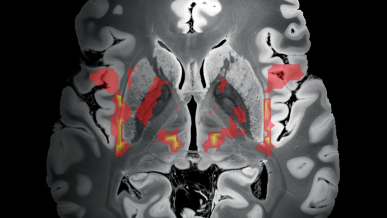 Neural Network Responsible for Tic Development Identified