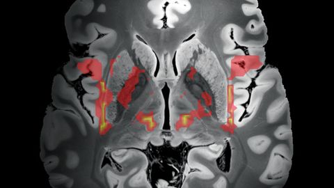 Neural Network Responsible for Tic Development Identified