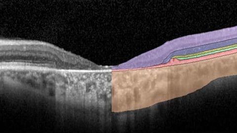 Deep Learning Approach Analyzes Vision Loss in Stargardt Disease