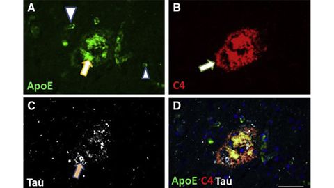 Protein Increases Dementia Risk, Even Without Mutations