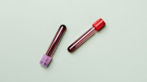 Blood Tests Could Make for Easier, More Reliable ALS Diagnosis