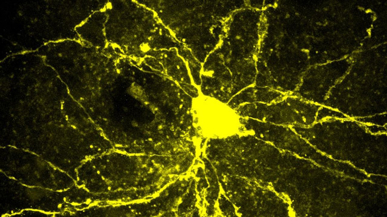 How Genes and Environment Combine To Produce the Complexity of Autism