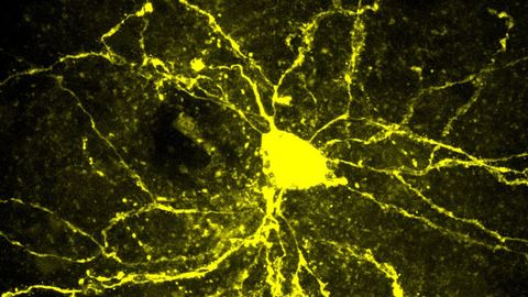 How Genes and Environment Combine To Produce the Complexity of Autism
