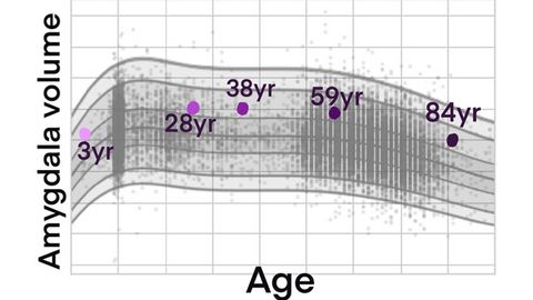 "Growth Charts" for the Brain Could Predict Disease Risk