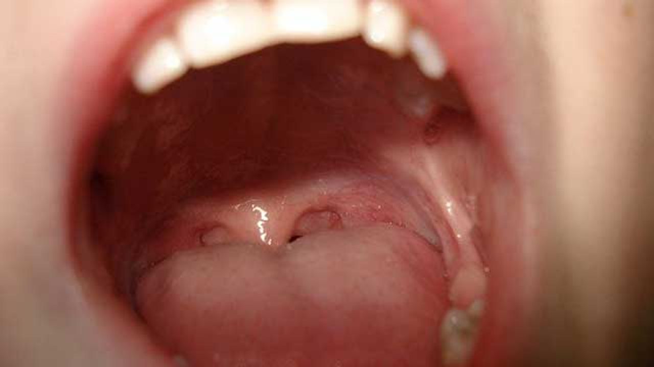 Prototype Insulin Patch Sticks Inside a Person’s Cheek