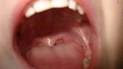 Prototype Insulin Patch Sticks Inside a Person’s Cheek
