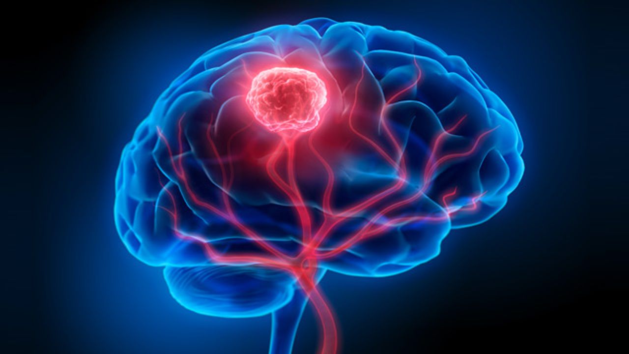 Anticancer Drug Shrinks Tumors in Almost a Third of Patients in Recurrent Glioblastoma Trial