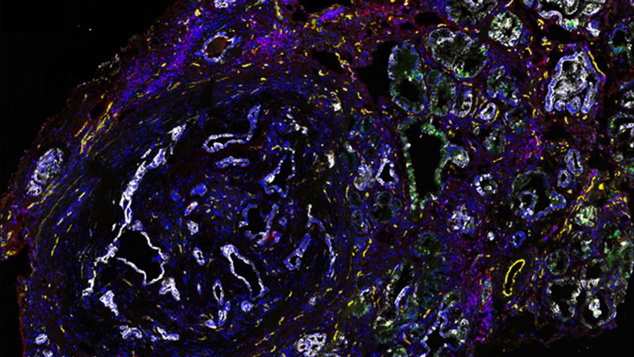 Pancreatic Cancer: Overcoming Resistance to Immunotherapies