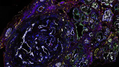 Pancreatic Cancer: Overcoming Resistance to Immunotherapies