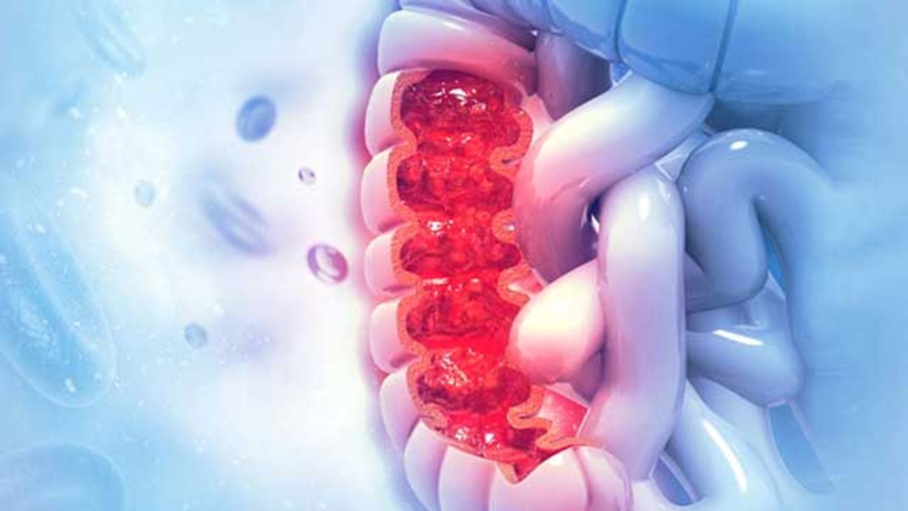 Understanding Polyps and Their Colorectal Cancer Counterparts