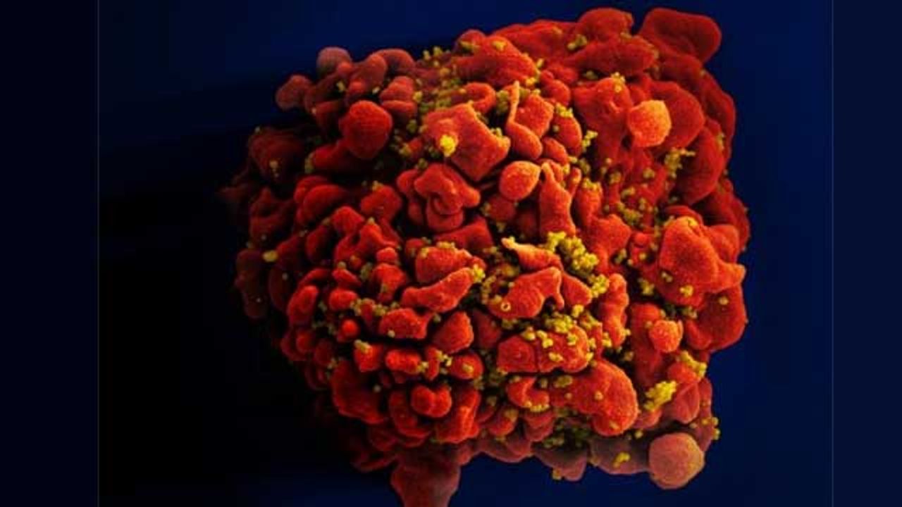 Third HIV Patient in Remission Following Stem Cell Transplant