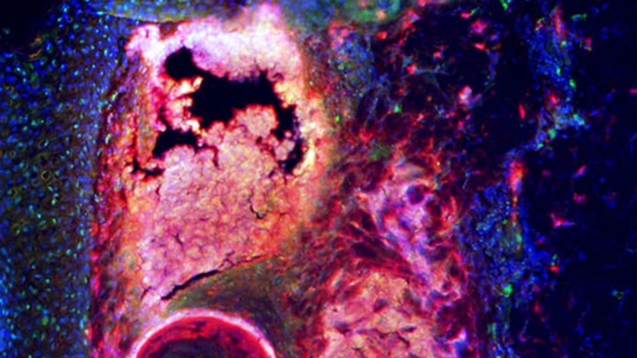 How Fat Cells in the Skin Help Fight Acne